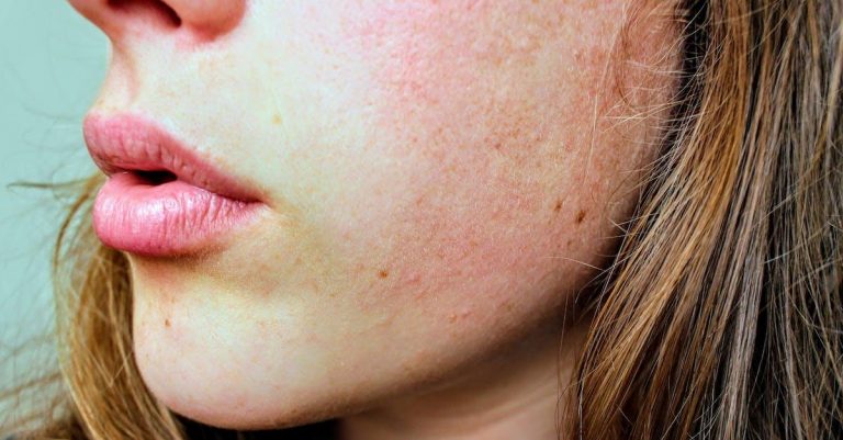 Forstå årsagerne til og forebyggelsen af tør hud